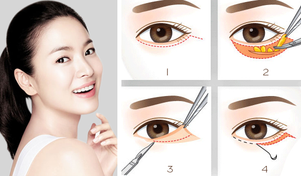 Trị bọng mắt bằng phương pháp tự nhiên – Trang sức khỏe làm đẹp collagen